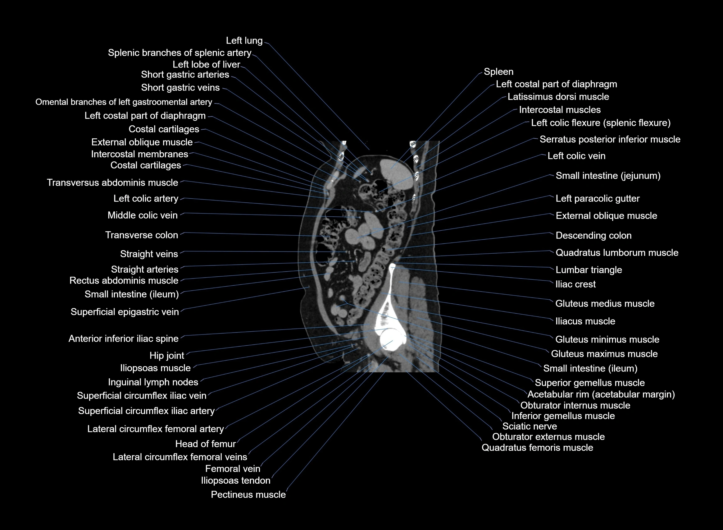 CT Abdomen sagittal cross sectional anatomy labelled radiology image -00028.webp
